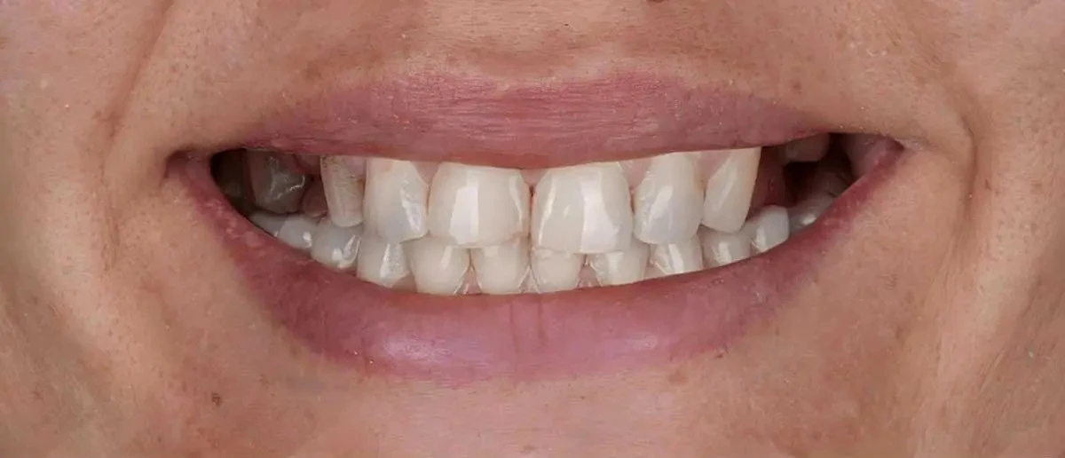 After smile treatment