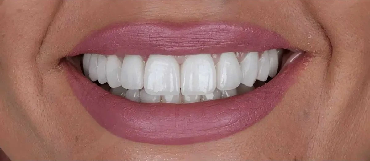 Before smile treatment